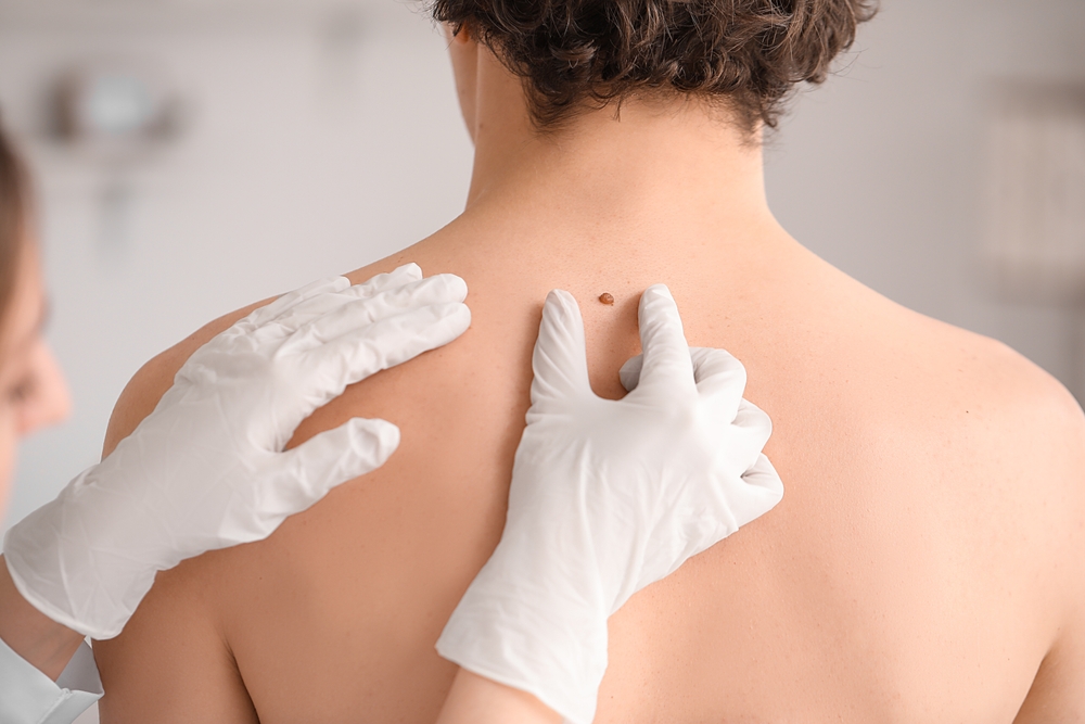 Is Mole Removal Painful? A Guide for Patients in Surrey