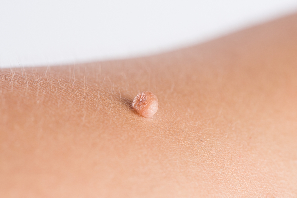 Skin Tag Removal in Surrey: What to Expect from Your Treatment