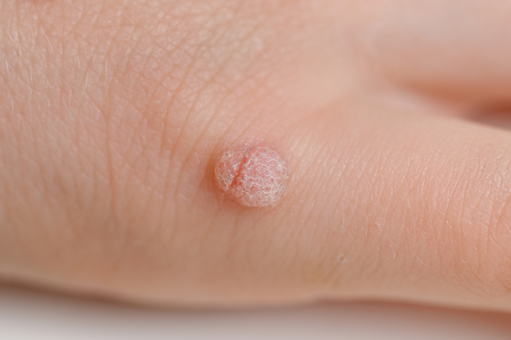Understanding Wart Removal: What Patients in Surrey Should Know